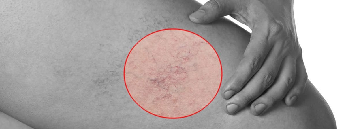 Thread Vein Removal Kent