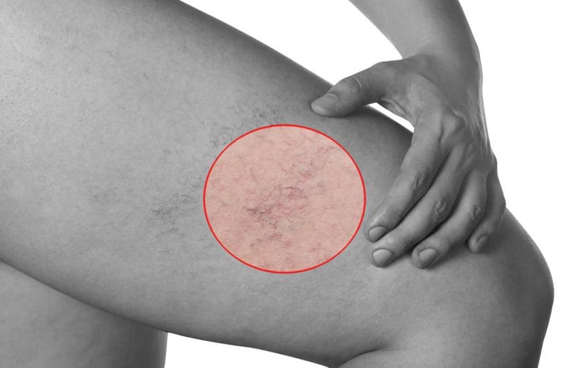 Thread Vein Removal Kent