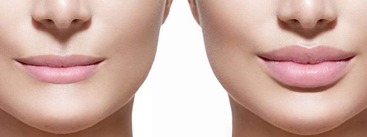 Dermal lip fillers