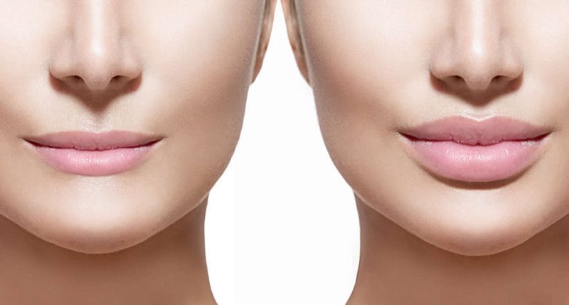 Dermal lip fillers