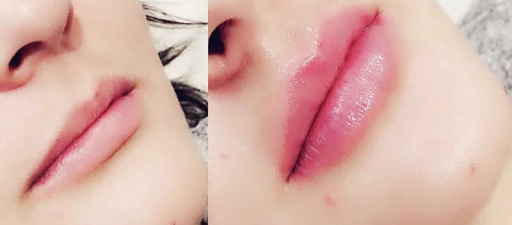 dermal fillers kent