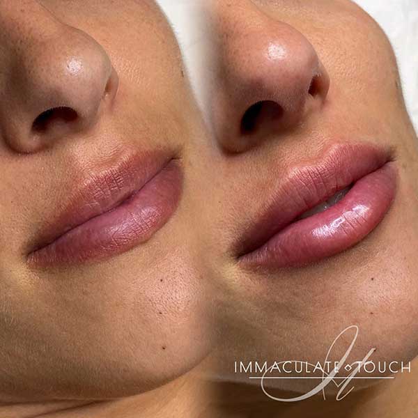 Dermal lip fillers - A before and after shot of what to expect if you visit us from Gravesend, Kent DA11, DA12 or DA13