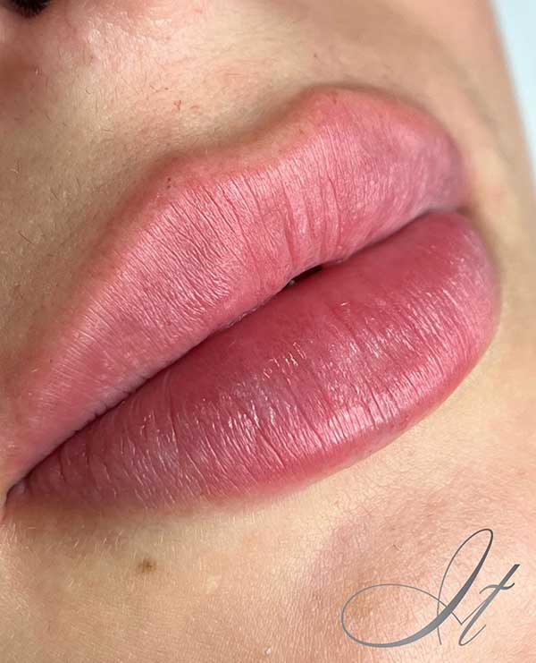 An example of natural-looking lip fillers