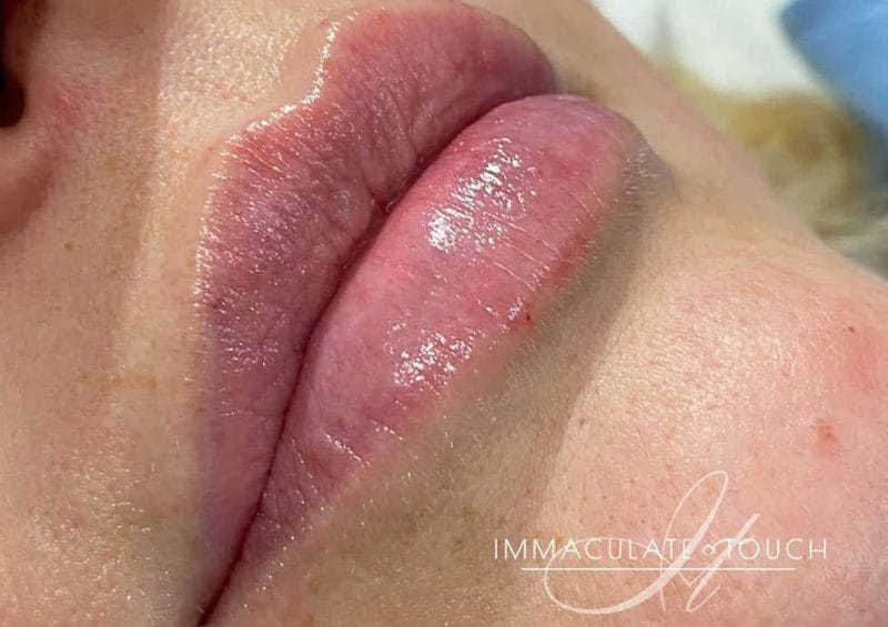 Why we're the best choice in Maidstone for dermal fillers