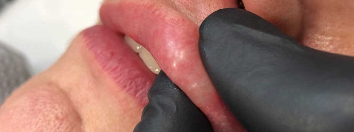Can dermal fillers be reversed, dissolved or removed?