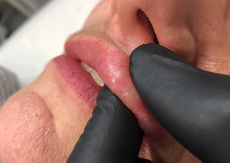 Can dermal fillers be reversed, dissolved or removed?