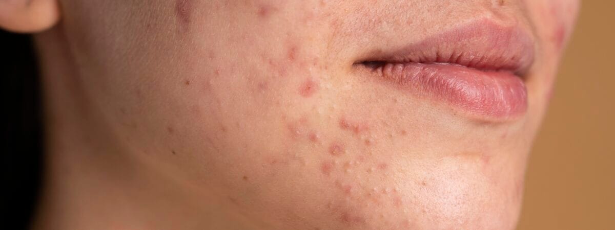 ipl acne treatment