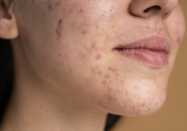 ipl acne treatment