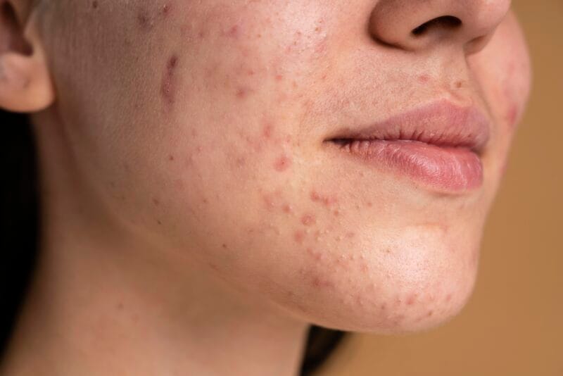 ipl acne treatment