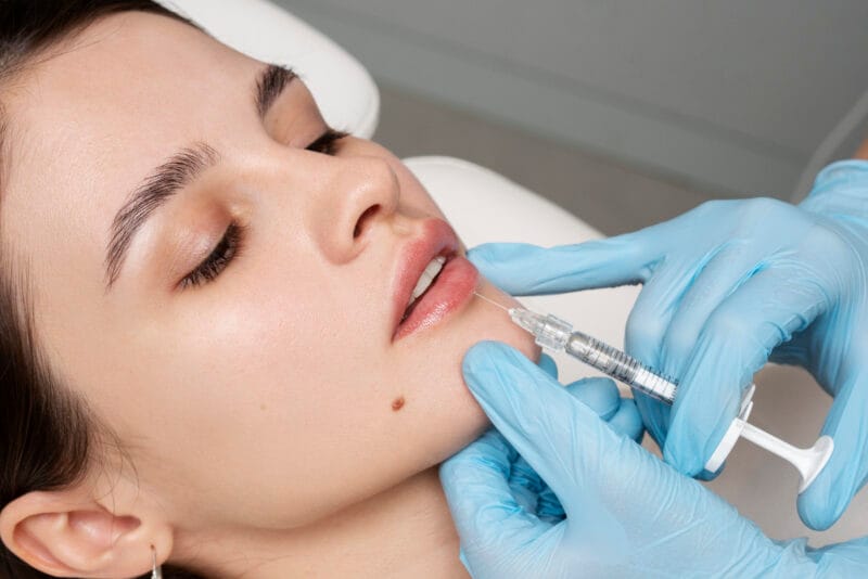 how long do lip fillers last