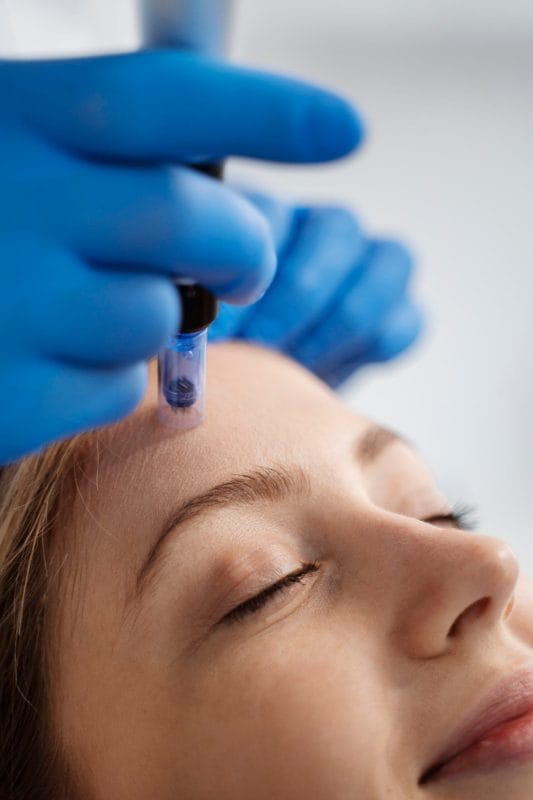 Does Microneedling Hurt?